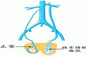 西昌哪家医院能治精索静脉曲张？